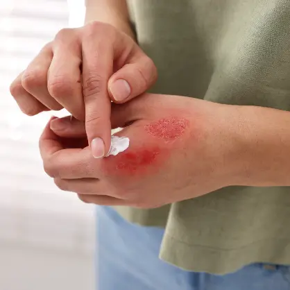 A close-up of a person applying white ointment or cream to a large red scrape or burn on the back of their hand